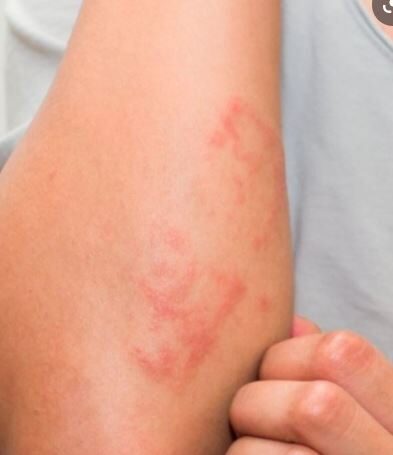 What is eczema and atopic
