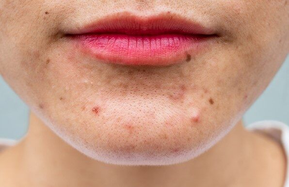 All that You Want to Know About Acne