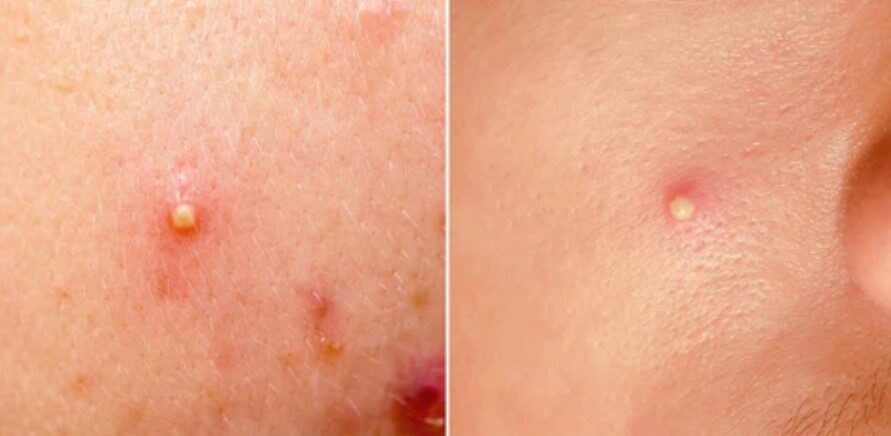 Pustules are small, red bumps on the skin that contain fluid or pus.